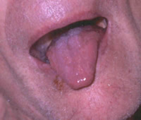 Tri-grooved appearance of the tongue